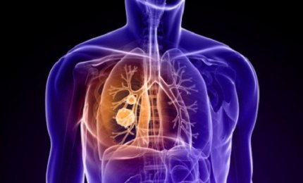 Scoperto il ruolo di un oncogene nel cancro al polmone