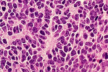 Trovata una nuova cura contro il medulloblastoma