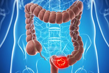 Stanziati due milioni e mezzo di euro per la prevenzione del tumore al colon-retto