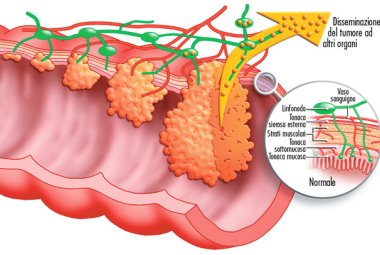 Nuove speranze per i malati di carcinoma colorettale