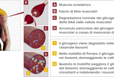 Malattia di Pompe, passi avanti nella sua conoscenza