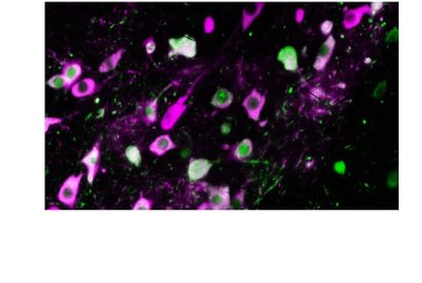  Fasi iniziali della malattia di Parkinson, scoperta un'alterazione del cervello