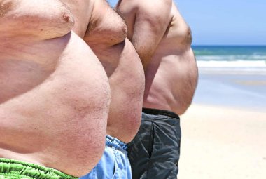 “Obesità: la pandemia silenziosa”