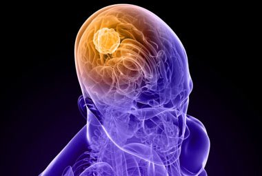 Le neoplasie del sistema nervoso in parole semplici