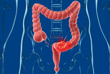Il gene SMC1A può portare ad una diagnosi precoce del tumore al colon-retto