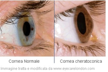 Al via la campagna di prevenzione e diagnosi del Cheratocono