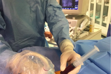Il piede diabetico curato a Lecce con un autotrapianto di cellule staminali