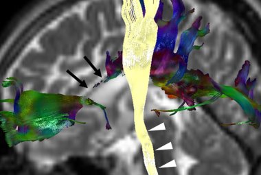 Un nuovo promettente approccio terapeutico per la paraplegia spastica ereditaria