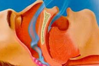 Nuove linee guida per la sindrome delle apnee ostruttive nel sonno (OSA)