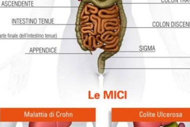 “Le MICI in ambito pediatrico. Un confronto con l'Ospedale Casa Sollievo della Sofferenza"