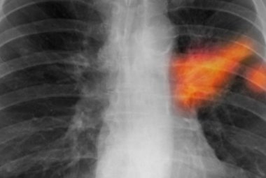 Tumore al polmone, lo studio su un nuovo farmaco 