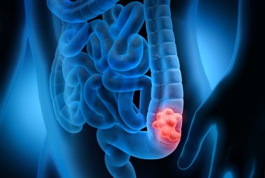 Le nanotecnologie per contrastare il tumore al colon