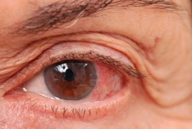 Per combattere il glaucoma (ladro silenzioso della vista) visite gratuite a Lecce e Copertino