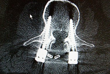 Le neoplasie vertebro-midollari, convegno al 'Fazzi'
