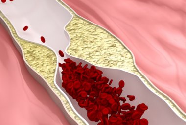  La recidiva del carcinoma prostatico spiegata dalla matematica