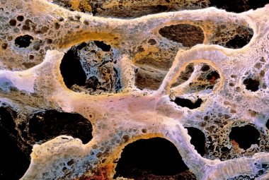 Rischio osteoporosi, controllo gratuito l'8 marzo