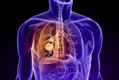 Scoperto il ruolo di un oncogene nel cancro al polmone
